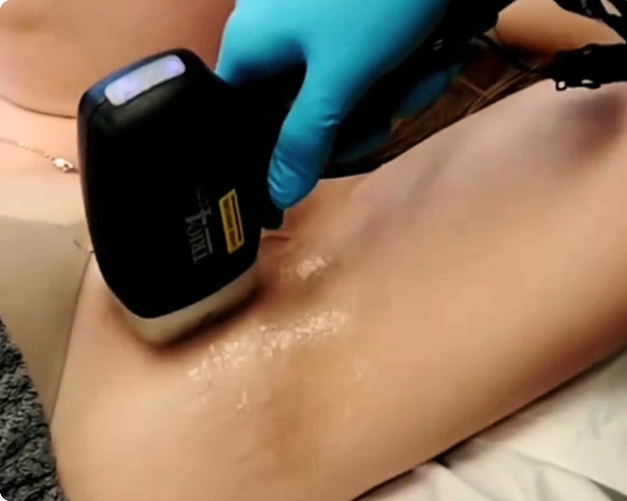 Laser Hair Removal products